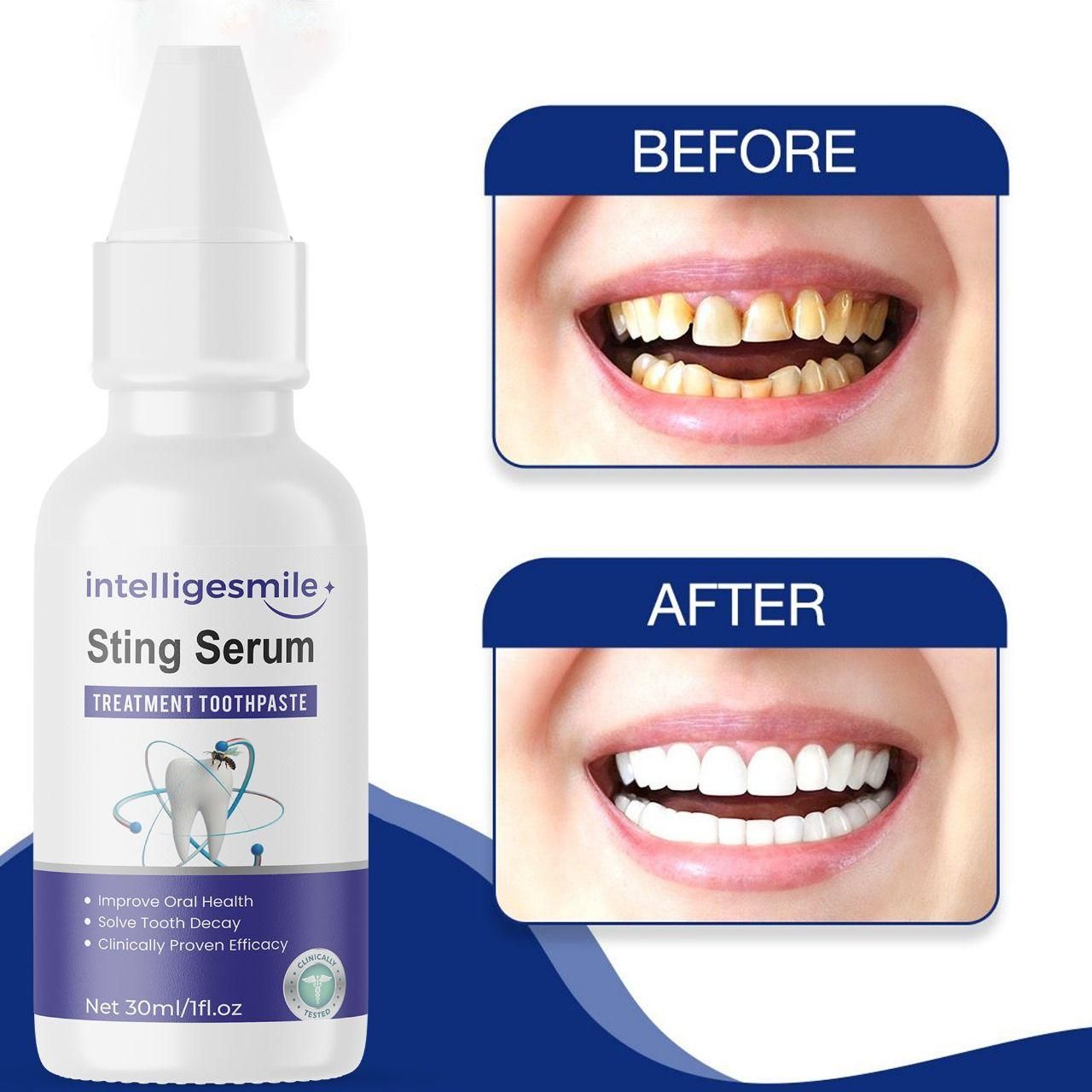 Intelligesmile Sting Serum Treatment Toothpaste 30ml Pack of 1 - Health Care